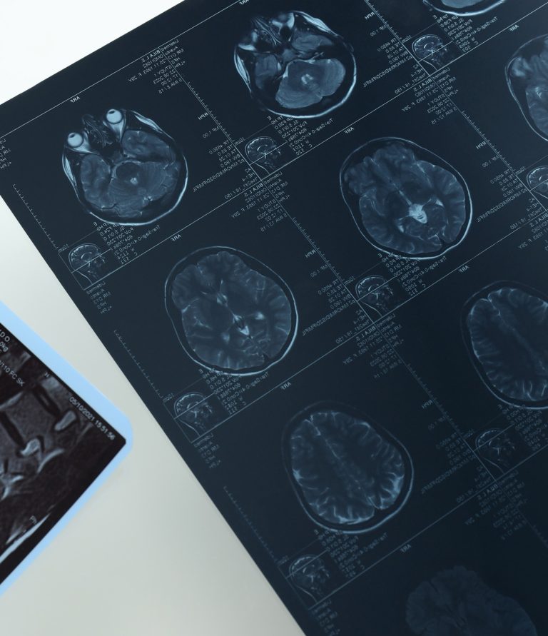 MRI or magnetic resonance imaging of the head and brain